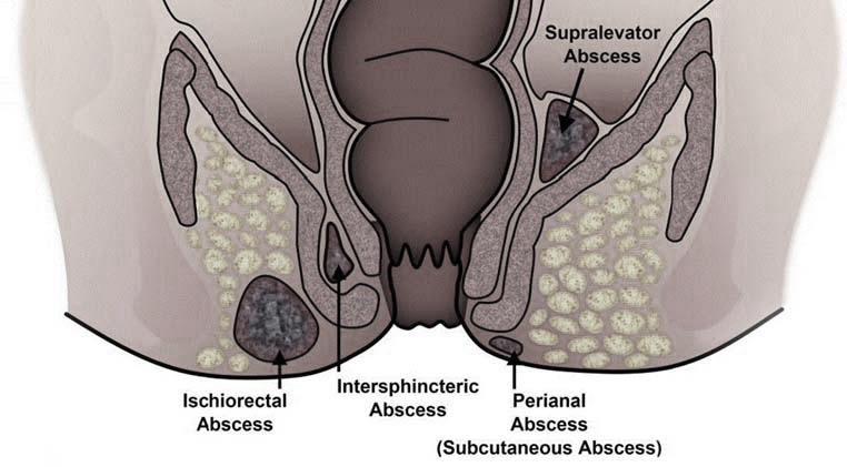 Abscesso Anorretal