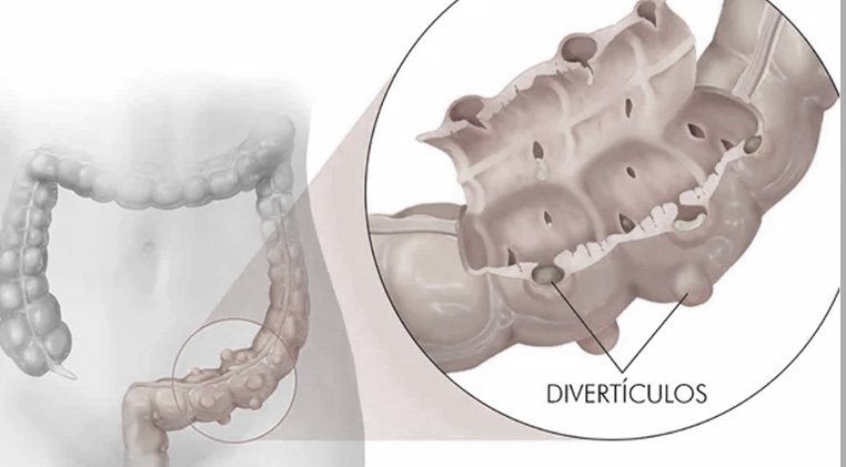 Doença Diverticular