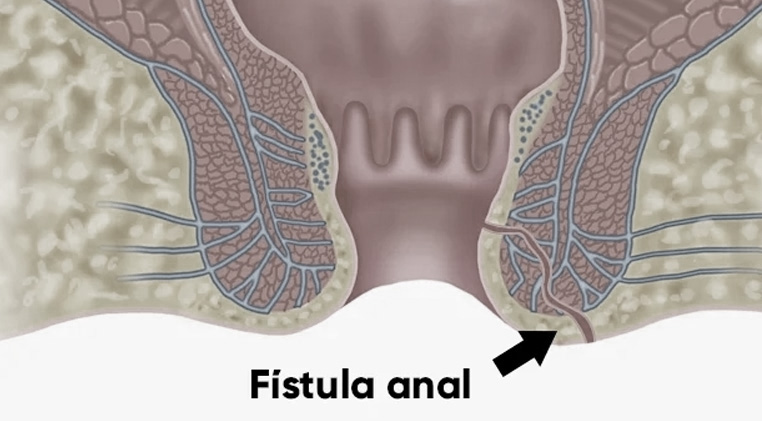 Fístula Anal