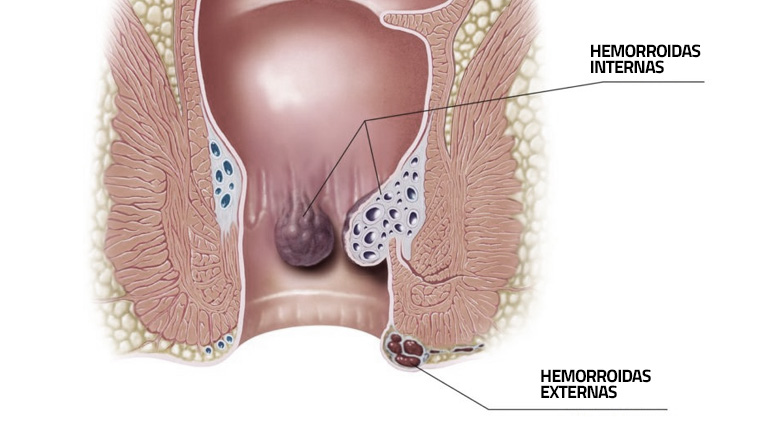 Hemorroidas